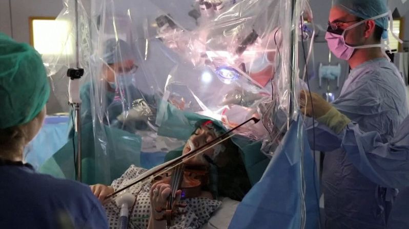 Pacientka během operace mozku hrála na housle, aby nepřišla o motoriku rukou